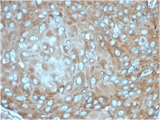 IHC staining of FFPE human skin squamous cell carcinoma with recombinant RPSA antibody (clone rRPSA/6333). HIER: boil tissue sections in pH 9 10mM Tris with 1mM EDTA for 20 min and allow to cool before testing.