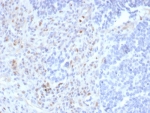 IHC staining of FFPE human lymph node tissue with recombinant PU.1 antibody (clone rPU1/2146). HIER: boil tissue sections in pH 9 10mM Tris with 1mM EDTA for 20 min and allow to cool before testing.