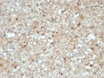 IHC staining of FFPE human brain tissue with S100B antibody (clone S100B/4143) at 2ug/ml. HIER: boil tissue sections in pH 9 10mM Tris with 1mM EDTA for 20 min and allow to cool before testing.