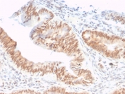 IHC staining of FFPE human colon adenocarcinoma tissue with CSTF2T antibody (clone PCRP-CSTF2T-1A3). HIER: boil tissue sections in pH 9 10mM Tris with 1mM EDTA for 20 min and allow to cool before testing.