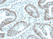 IHC staining of FFPE human prostate carcinoma tissue with recombinant FOXP1 antibody (clone FOXP1/44R) at 1ug/ml. HIER: boil tissue sections in pH 9 10mM Tris with 1mM EDTA for 20 min and allow to cool before testing.