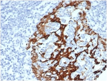 IHC staining of FFPE human prostate tissue with Cytokeratin 6A antibody (clone KRT6/3997R). HIER: boil tissue sections in pH 9 10mM Tris with 1mM EDTA for 20 min and allow to cool before testing.~