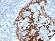 IHC staining of FFPE human prostate tissue with Cytokeratin 6A antibody (clone KRT6/3997R). HIER: boil tissue sections in pH 9 10mM Tris with 1mM EDTA for 20 min and allow to cool before testing.