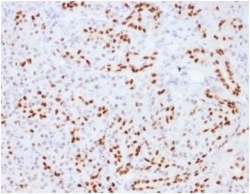 IHC staining of FFPE human pancreatic tissue with SOX9 antibody (clone SOX9/2104) HIER: boil tissue sections in pH 9 10mM Tris with 1mM EDTA for 20 min and allow to cool before testing.