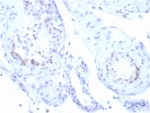 IHC staining of FFPE human testicular carcinoma tissue with recombinant StAR antibody (clone STAR/3915R). HIER: boil tissue sections in pH 9 10mM Tris with 1mM EDTA for 20 min and allow to cool before testing.