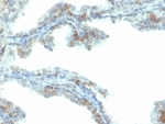 IHC staining of FFPE human prostate carcinoma tissue with ERG antibody (clone ERG/2107). HIER: boil tissue sections in pH 9 10mM Tris with 1mM EDTA for 20 min and allow to cool before testing.