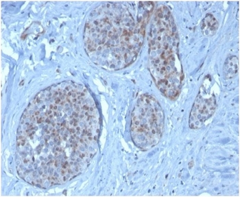 IHC staining of FFPE human pancreatic tissue with MDM2 antibody (clone MDM2/3277). HIER: boil tissue sections in pH 9 10mM Tris with 1mM EDTA for 20 min and allow to cool before testing.