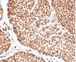 IHC staining of FFPE human bladder carcinoma tissue with TCF4 antibody (clone TCF4/2252) at 2ug/ml. HIER: boil tissue sections in pH 9 10mM Tris with 1mM EDTA for 20 min and allow to cool before testing.