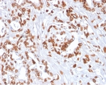 IHC staining of FFPE human breast carcinoma tissue with TCF4 antibody (clone TCF4/2252) at 2ug/ml. HIER: boil tissue sections in pH 9 10mM Tris with 1mM EDTA for 20 min and allow to cool before testing.~