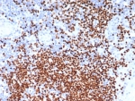 IHC staining of FFPE human lymph node tissue with SOX11 antibody (clone SOX11/7236). HIER: boil tissue sections in pH 9 10mM Tris with 1mM EDTA for 20 min and allow to cool before testing.