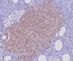 IHC staining of FFPE human mantle cell lymphoma tissue with SOX11 antibody (clone SOX11/7236). HIER: boil tissue sections in pH 9 10mM Tris with 1mM EDTA for 20 min and allow to cool before testing.