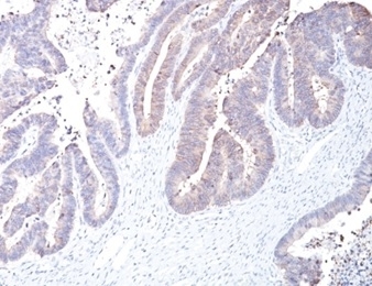 IHC staining of FFPE human colon carcinoma tissue with COX2 antibody (clone COX2/2377). HIER: boil tissue sections in pH 9 10mM Tris with 1mM EDTA for 20 min and allow to cool before testing.