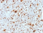 IHC staining of FFPE human Hodgkins Lymphoma tissue with PU.1 antibody (clone PU1/2118). HIER: boil tissue sections in pH 9 10mM Tris with 1mM EDTA for 20 min and allow to cool before testing.