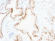IHC analysis of formalin-fixed, paraffin-embedded human prostate carcinoma stained with p27 antibody (clone SPM348).