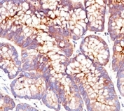 IHC: Formalin-fixed, paraffin-embedded human colon carcinoma stained with CEA antibody (SPM541)