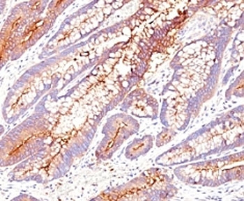 IHC: Formalin-fixed, paraffin-embedded human colon carcinoma stained with CEA antibody (SPM584).~