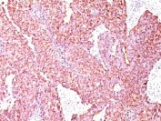 IHC: Formalin-fixed, paraffin-embedded human small cell lung carcinoma stained with Chromogranin A antibody (SPM585)