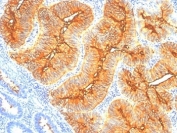 IHC: Formalin-fixed, paraffin-embedded human colon carcinoma stained with TAG-72 antibody (clone SPM148).