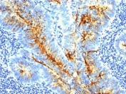 IHC: Formalin-fixed, paraffin-embedded human colon carcinoma stained with TAG-72 antibody (clone SPM536).