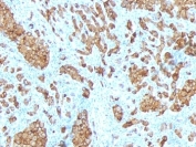 IHC: Formalin-fixed, paraffin-embedded human melanoma stained with anti-Melan-A antibody (SPM342).