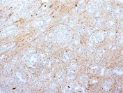 IHC: Formalin-fixed, paraffin-embedded human pancreatic adenocarcinoma stained with Fibronectin antibody (SPM539).