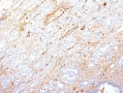 IHC: Formalin-fixed, paraffin-embedded human pancreatic adenocarcinoma stained with Fibronectin antibody (SPM246).