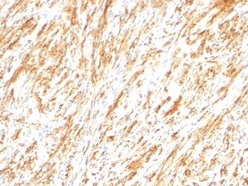 IHC: Formalin-fixed, paraffin-embedded human schwanoma stained with Glial Fibrillary Acidic Protein antibody (clone SPM248).~