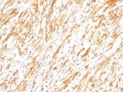IHC: Formalin-fixed, paraffin-embedded human schwanoma stained with Glial Fibrillary Acidic Protein antibody (clone SPM248).