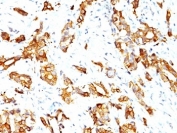IHC: Formalin-fixed, paraffin-embedded human breast carcinoma stained with HSP27 antibody (clone SPM252).