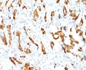 IHC: Formalin-fixed, paraffin-embedded human breast carcinoma stained with HSP27 antibody (clone SPM252).