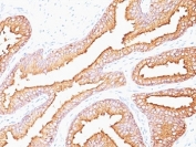 IHC: Formalin-fixed, paraffin-embedded human prostate carcinoma stained with PSA antibody (SPM352).