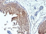 IHC: Formalin-fixed, paraffin-embedded human bladder carcinoma stained with Cytokeratin 6 antibody (clone SPM269).