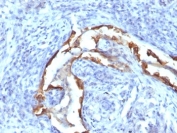 IHC: Formalin-fixed, paraffin-embedded human lung carcinoma stained with Cytokeratin 8 antibody (clone SPM538).