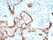 IHC: Formalin-fixed, paraffin-embedded human lung carcinoma stained with Cytokeratin 8 antibody (clone SPM192).