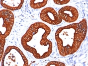 IHC: Formalin-fixed, paraffin-embedded human colon carcinoma stained with Cytokeratin 18 antibody (clone SPM265).