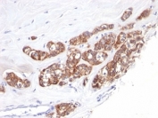 IHC: Formalin-fixed, paraffin-embedded human breast carcinoma stained with anti-Cytokeratin 18 antibody (clone SPM510).