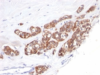 IHC: Formalin-fixed, paraffin-embedded human breast carcinoma stained with a