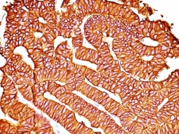 IHC: Formalin-fixed, paraffin-embedded human colon carcinoma stained with EpCAM antibody (SPM528).