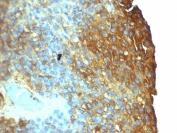 IHC: Formalin-fixed, paraffin-embedded human melanoma stained with Moesin antibody (clone SPM562).
