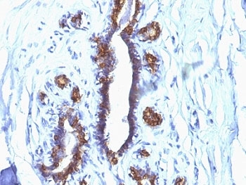 IHC: Formalin-fixed, paraffin-embedded human breast cancer stained with EMA antibody (clone SPM132).