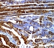 IHC: Formalin-fixed, paraffin-embedded human colon carcinoma stained with MUC2 antibody (SPM296).