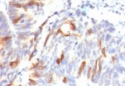 IHC: Formalin-fixed, paraffin-embedded human colon carcinoma stained with Mucin-2 antibody (SPM513).