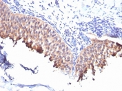 IHC: Formalin-fixed, paraffin-embedded human bladder carcinoma stained with Cytokeratin 10 antibody (SPM261).