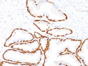 IHC: Formalin-fixed, paraffin-embedded human prostate carcinoma stained with anti-Cytokeratin 14 antibody (clone SPM263).