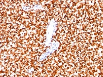 IHC: Formalin-fixed paraffin-embedded human Ewing's sarcoma stained with NKX2.2 antibody (clone SPM564).~