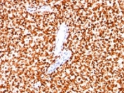 IHC: Formalin-fixed paraffin-embedded human Ewing's sarcoma stained with NKX2.2 antibody (clone SPM564).