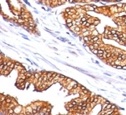 IHC: Formalin-fixed, paraffin-embedded human prostate carcinoma stained with ODC-1 antibody (clone SPM565).