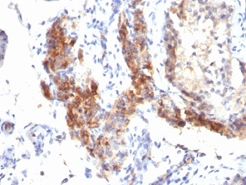 IHC: Formalin-fixed, paraffin-embedded human testicular carcinoma stained with FOXP3 antibody (SPM579).