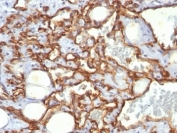 IHC: Formalin-fixed, paraffin-embedded human Angiosarcoma stained with anti-CD31 antibody (clone SPM532).