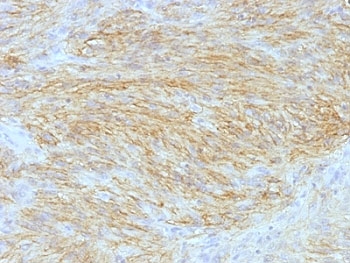 IHC: Formalin-fixed, paraffin-embedded human GIST stained with ANO1 antibody (clone SPM580).